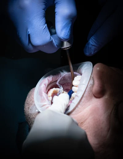 Intervento di chirurgia dentale su un paziente
