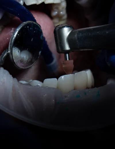Dottore che passa una fresa su un dente di un paziente