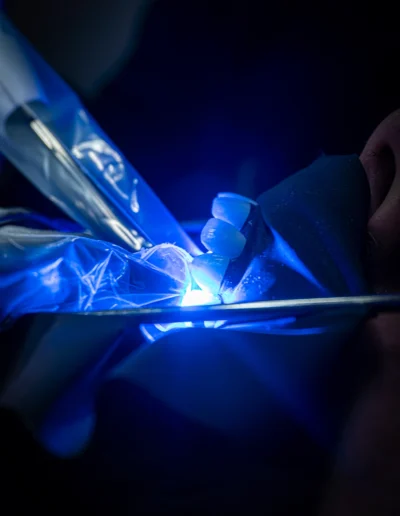 Laser dentale per chiudere definitivamente la sigillatura radicolare