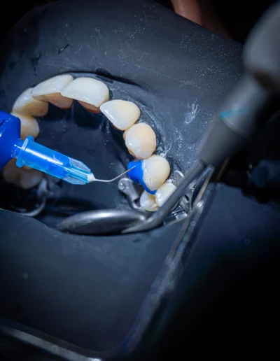 Intervento di sigillatura radicolare dentale
