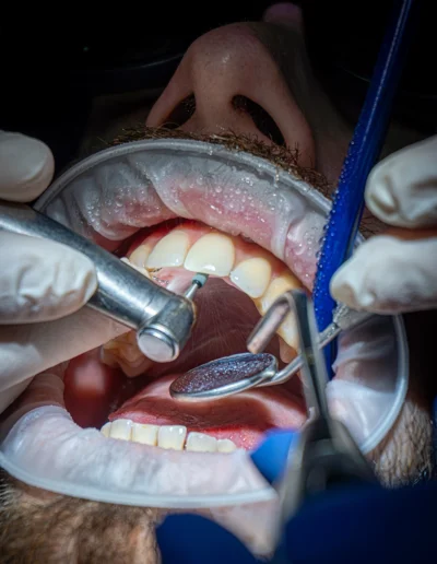 Dentista che rimuove splintaggio superiore dall'arcata di un paziente