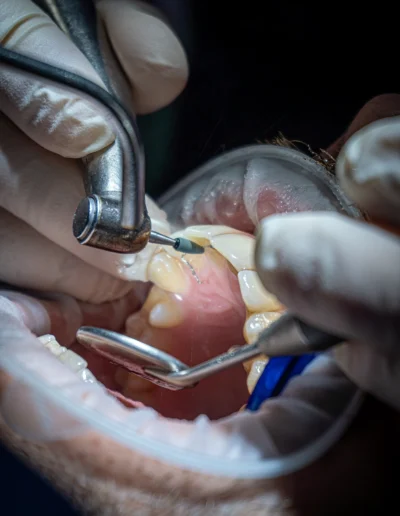 Dentista che rimuove splintaggio superiore dall'arcata di un paziente