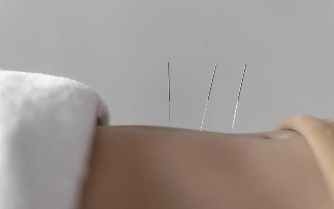 Agopuntura per i Disturbi Digestivi: Un Rimedio Naturale per Colon Irritabile, Gastrite e Non Solo