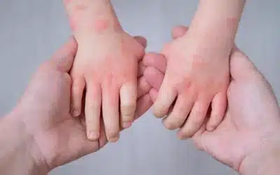 Eczema nei bambini: cause, sintomi e rimedi efficaci