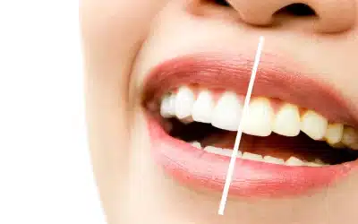 Sbiancamento dentale a Corte Franca (Brescia)