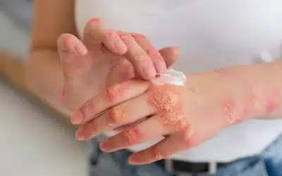 Funghi e micosi: capire le cause per curarle senza paura