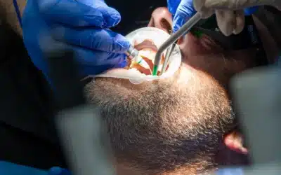Addio trapano! Come funziona il laser e perché conviene sceglierlo a Corte Franca (Brescia)