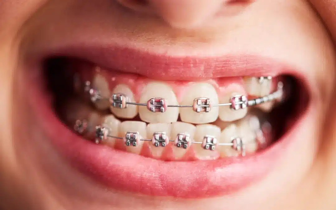 Apparecchio dentale: dove andare e cosa sapere a Corte Franca – (Brescia)