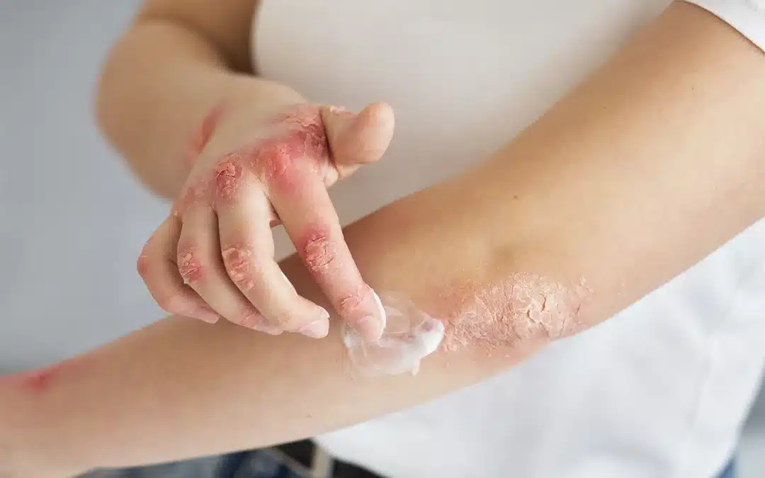 Psoriasi: cos’è, come si manifesta e perché non va sottovalutata – Info utili per chi vive a Corte Franca
