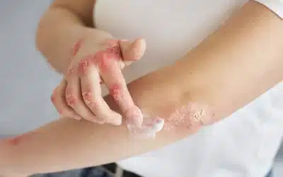 Psoriasi: cos’è, come si manifesta e perché non va sottovalutata – Info utili per chi vive a Corte Franca